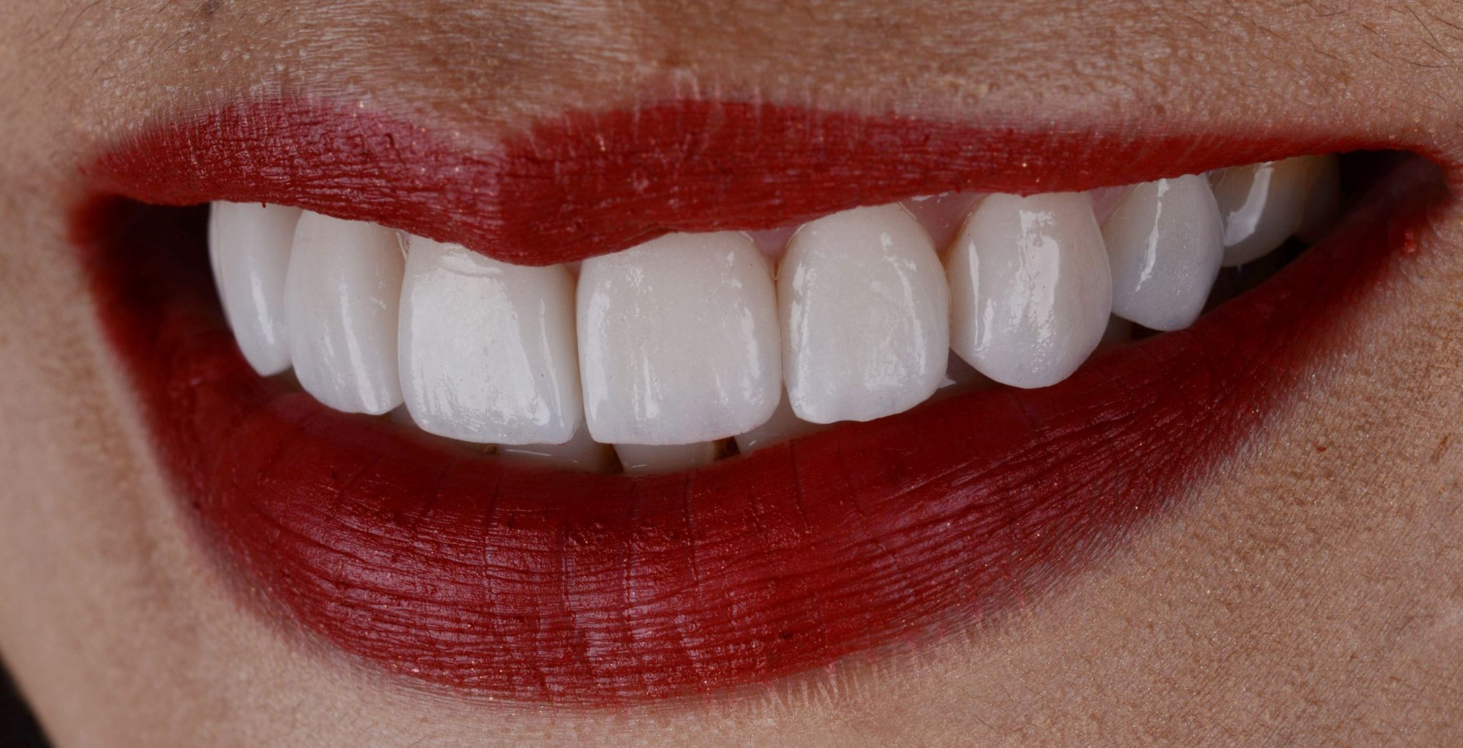 teeth whitening Alexandra Dental Clinic